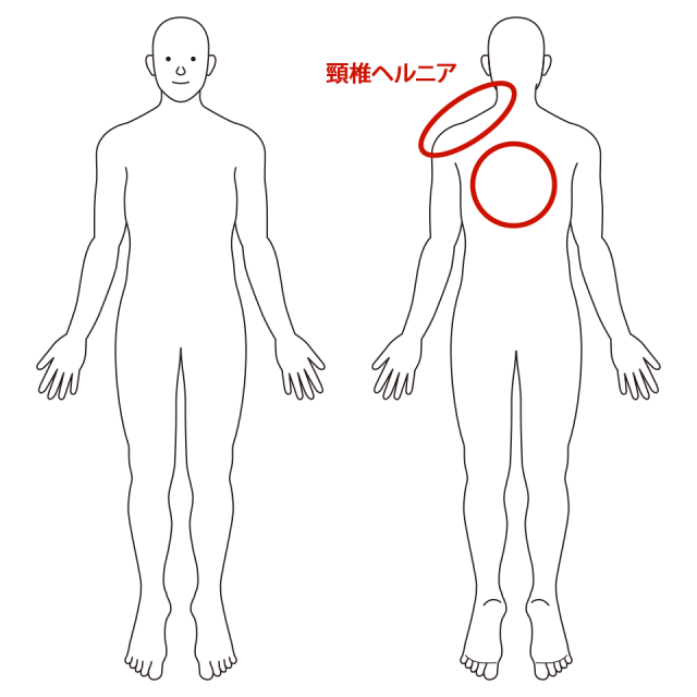 左の首から肩、背中にかけて